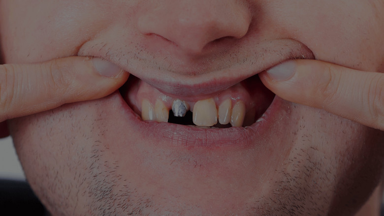 Why is research important before getting dental implants?