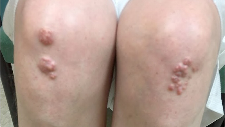 As with most conditions of Elbow Lesions, prevention is better than treatment