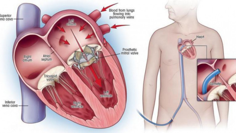 In the treatment of severe mitral regurgitation, Transcatheter Mitral Valve Repair and Replacement may be used as an alternative therapeutic option
