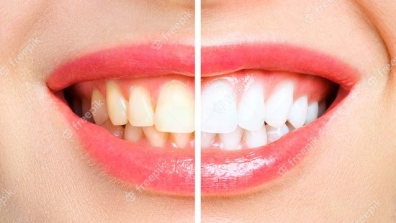 How can I whiten my teeth