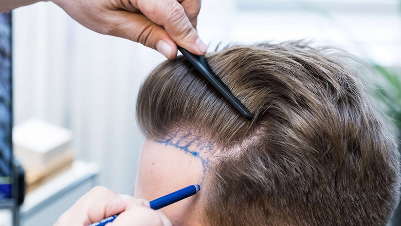 Contrata los mejores servicios de clínica de trasplante de cabello en Quito