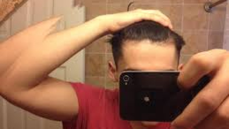 Men Hair Loss Causes and Treatments