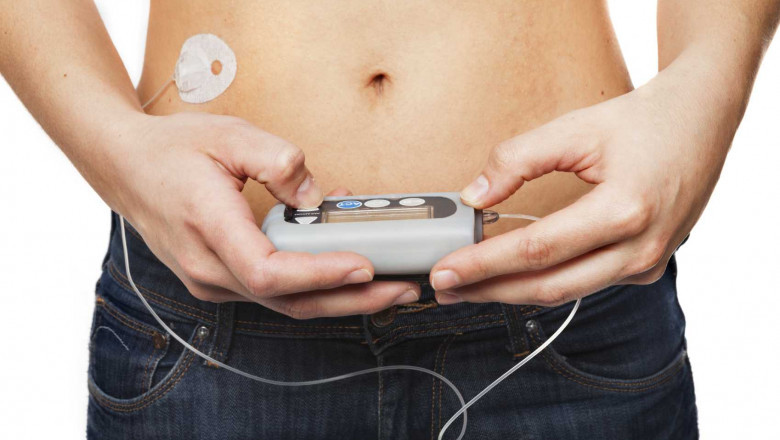 An Insulin Pumps administers insulin at a basal rate, in which a modest amount of insulin is supplied constantly throughout the day to maintain normal body