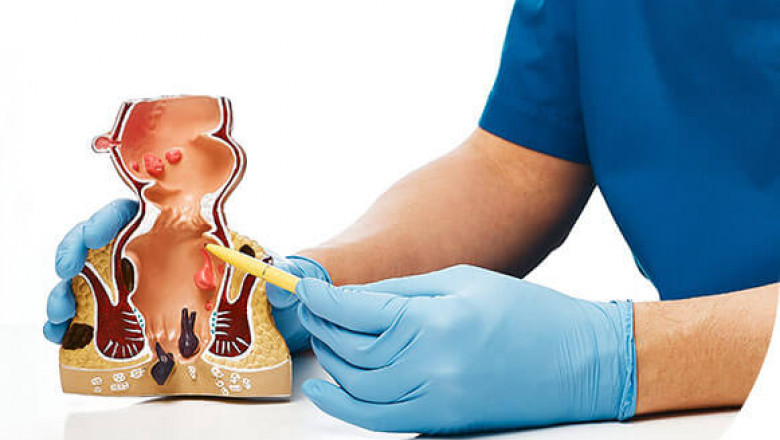 How do I get rid of my fistula problems? What is the effective surgery for fistula?