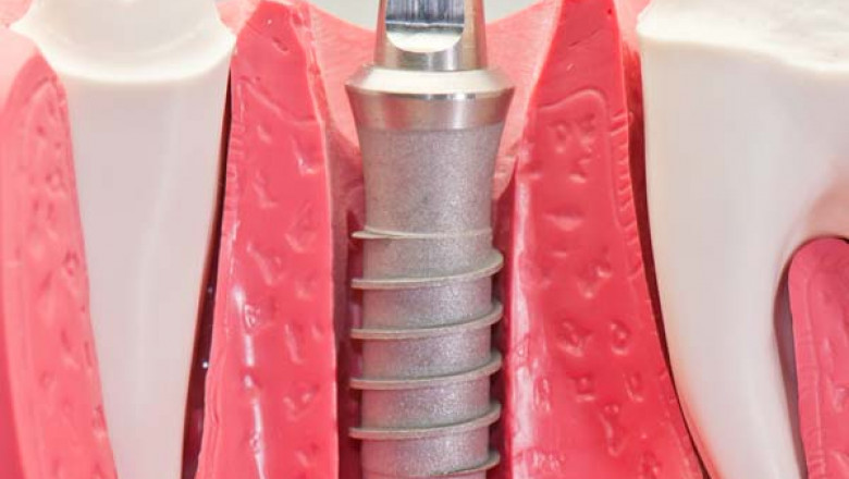 Why are dental implants good for you?