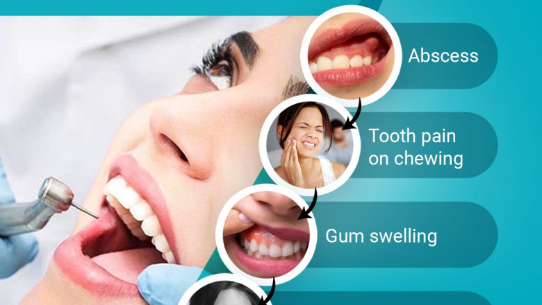 Why Do I Need Root Canal Treatment