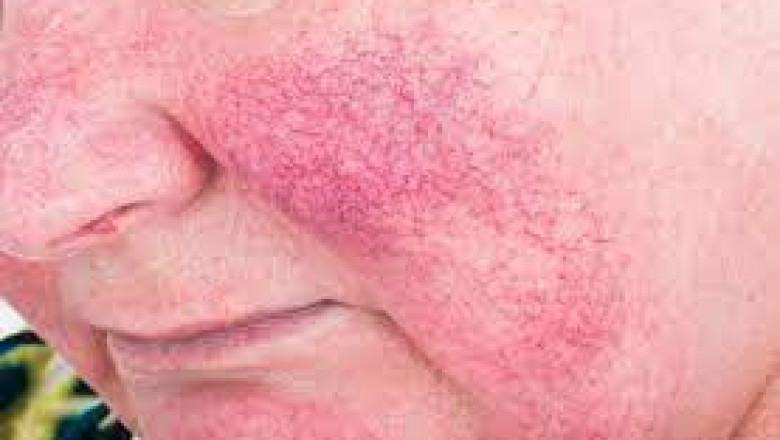 Why Vitamin C is good for skin