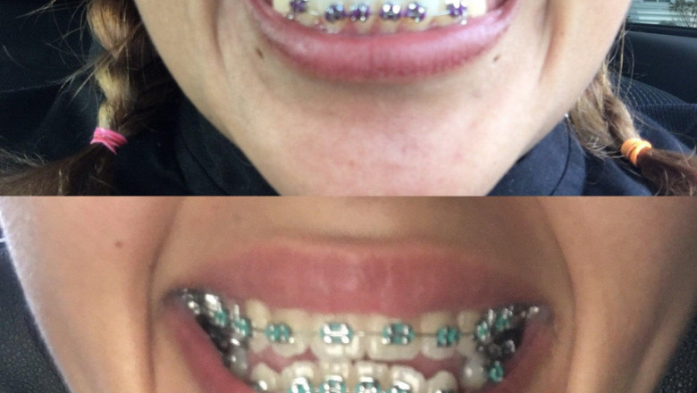 Ceramic braces: What Are The Main Benefits?