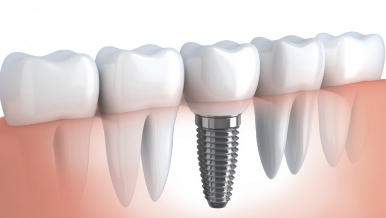 All You Need To Know About Temporomandibular Joint (TMJ)