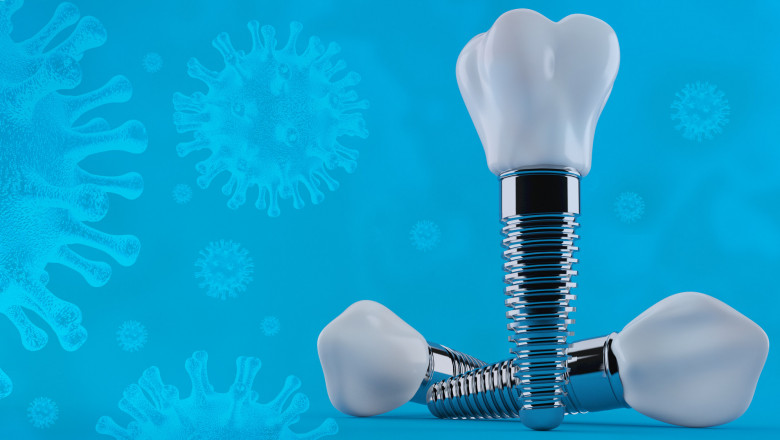 How to care for dental implants