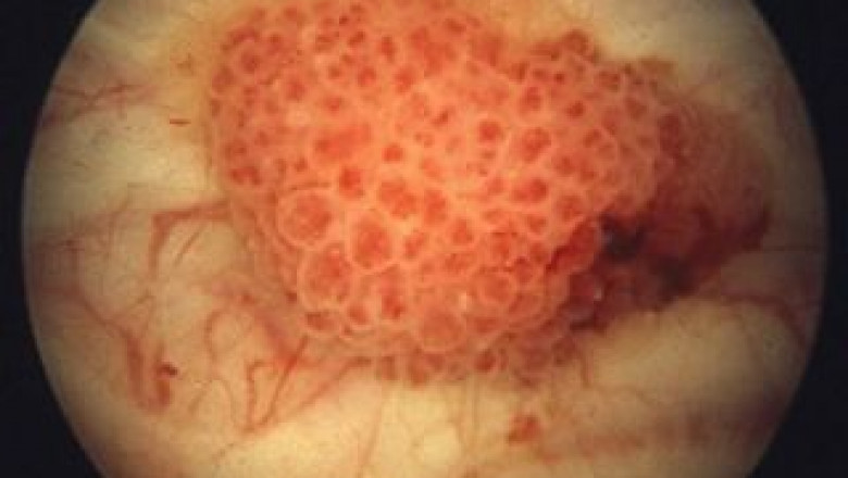 Bladder Cancer Market Size, Upcoming Trends, On-Going Demand, Growth and Forecast from 2021 to 2027