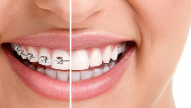How To Find Affordable Braces Miami?