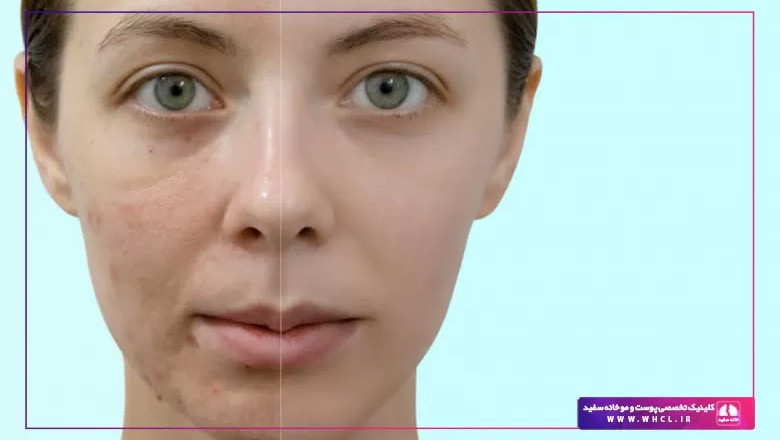 The best ways to get rid of pimples and treat acne