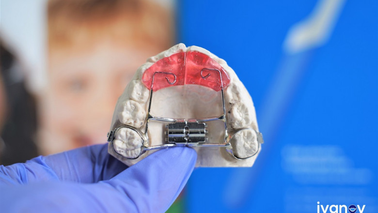 What Are the Different Types Of Teeth Alignment Methods Available?