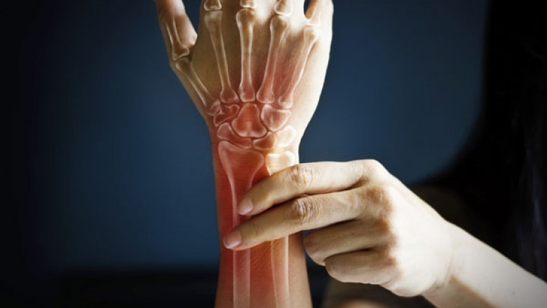 A Guide to Bone Density Test