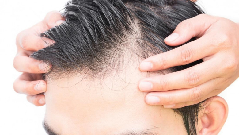 How To Get Safe And Effective Hair Transplant Surgery?