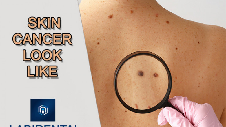 What Does Skin Cancer Look Like? - LabirentAI