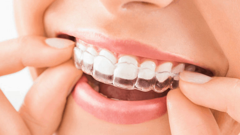 Do You Want To Know More About Invisible Braces? Read Here!