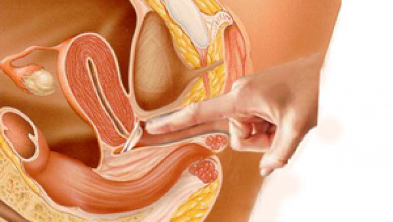Insemination