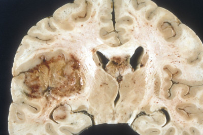 Glioblastoma Multiforme Treatment Industry  See Huge Growth for New Normal | Research Informatic