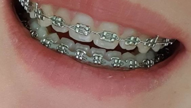 What Are Dental Braces Types?