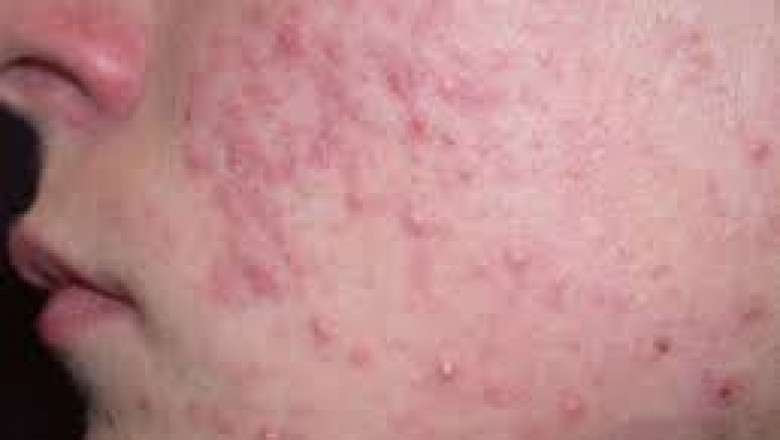 Acne Vulgaris Treatment Market - GROWTH, TRENDS, COVID-19 IMPACT, AND FORECASTS (2021 – 2026)