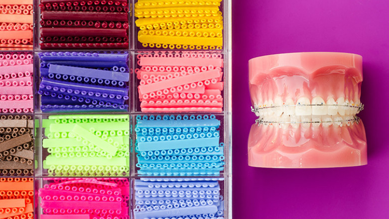 What Color Braces Can Be Most Attractive For Everyone?