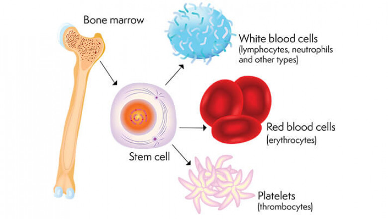 What Are The Complications of a Bone Marrow Transplantation?