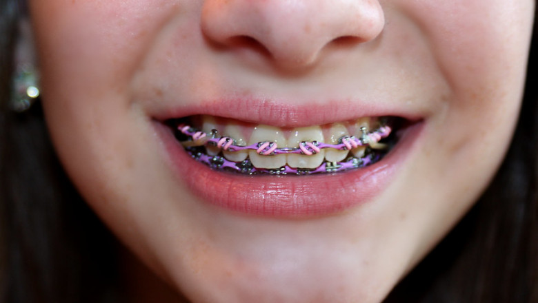 What Are The Unique Braces Color Combinations?