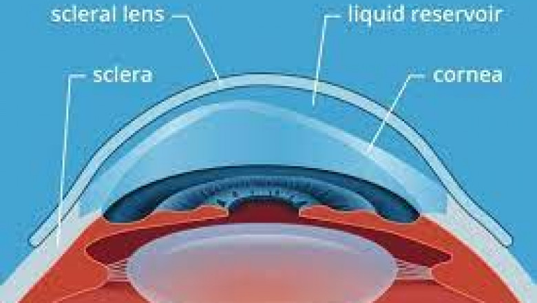 Scleral Lens Market Size 2021, Latest Trends, Status, Global Growth and Share Forecast to 2026