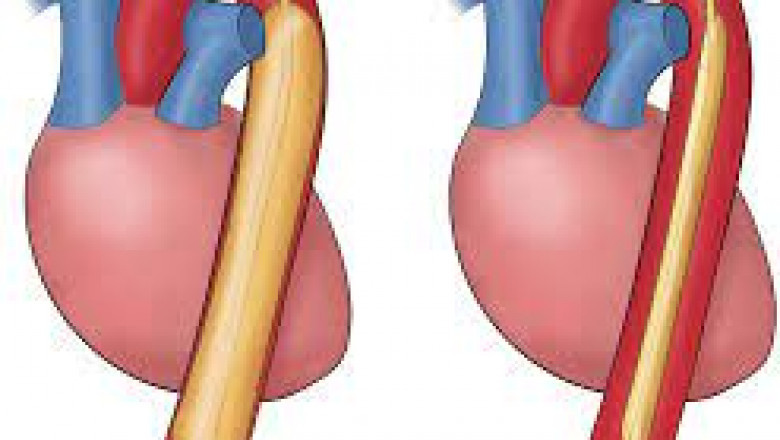 Intra-Aortic Balloon Pump (IABP) Market Regional Outlook,Competitive Analysis and segment Forecast to 2026