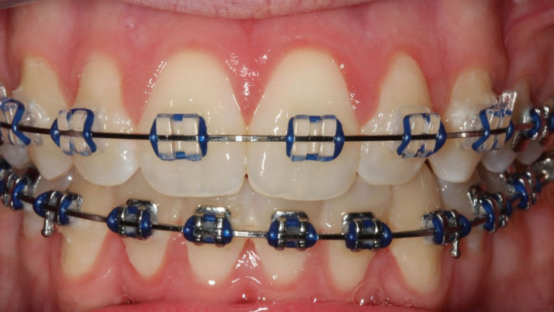 Things to Think About When Picking The Braces Colour