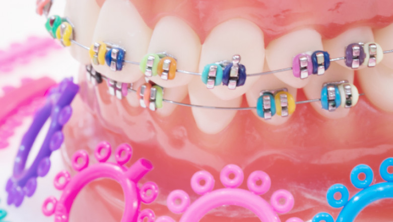 What Color Braces Are More Attractive?