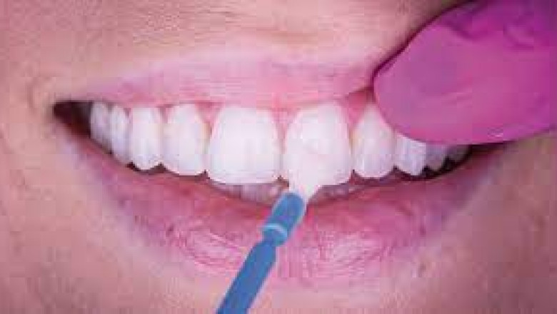 Fluoride Varnish Market Industry Analysis by Current Trends, Production, Sales and Consumption, Share and Global Growth Forecast to 2026