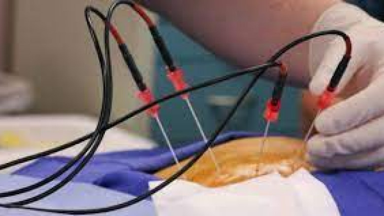 Ablation Technologies Market Healthy Growth and Competitive Analysis 2021 to 2026