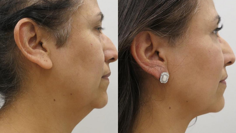 What Are Face Lifting Surgery And Its Advantages?