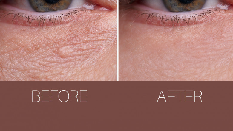 Explore Option on Eyelid blepharoplasty
