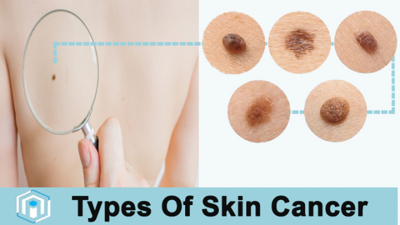 Types Of Skin Cancer | Pictures Of Skin Cancer