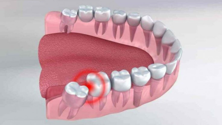 What are the Multiple Stages of Periodontal Disease?