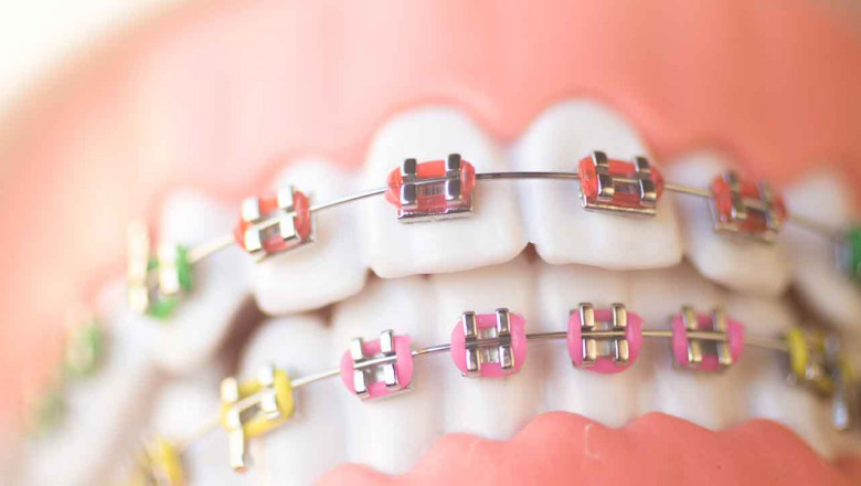 What Braces Colors are Available and How to Choose?