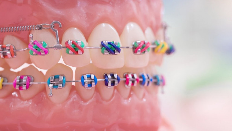 What Color Braces Should You Select?
