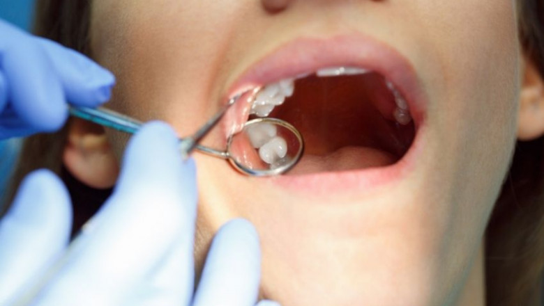 How Long Does A Root Canal Take?