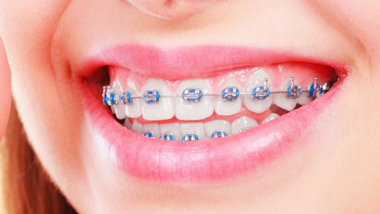 Do We Have Other Options Than Metal Braces?
