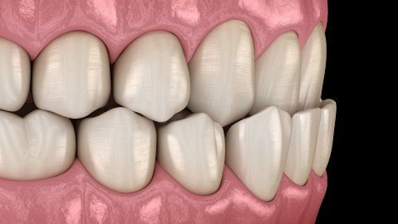 What Are The Advantages Root Canal Treatment