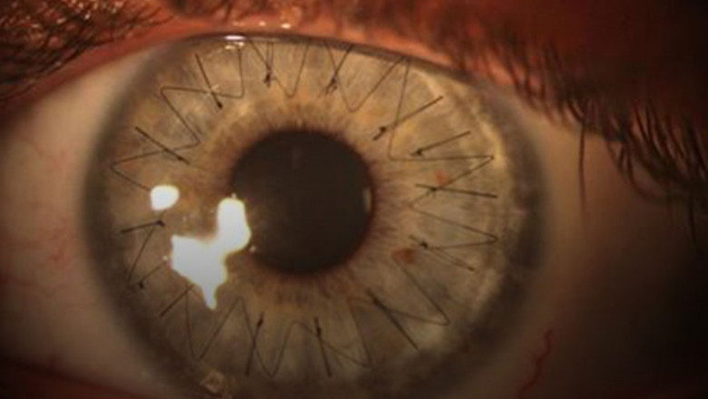 All About Cornea Surgery