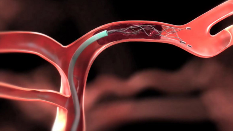 Thrombectomy Devices Market Share Forecast 2027 | Research Informatic