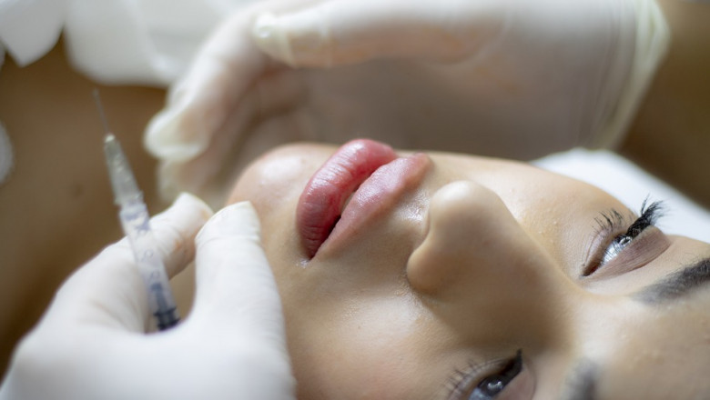 Few Facts About Lip Augmentation Using Fillers