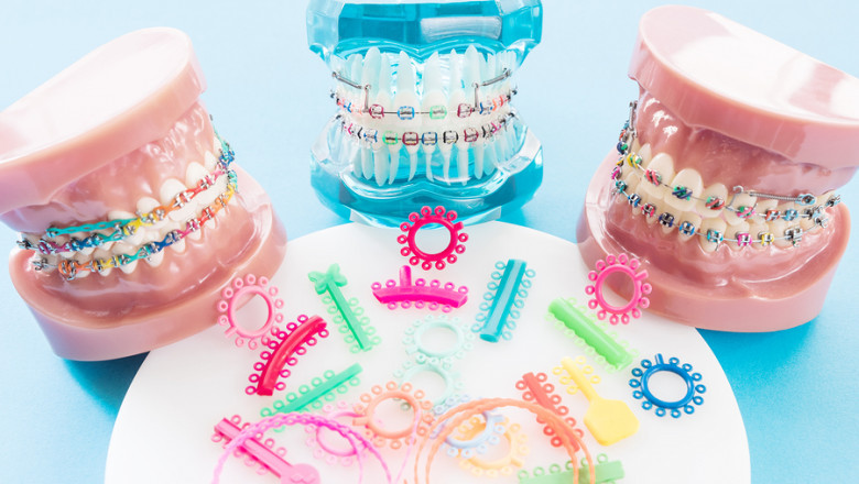Can You Change The Color Of Your Braces?