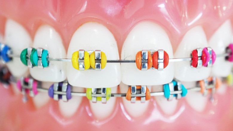 Do Colorful Braces Hurt?