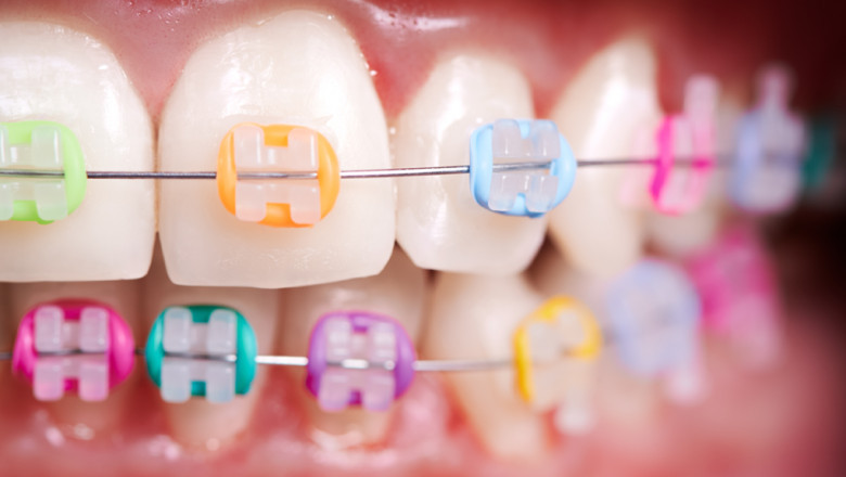 How Do I Find An Orthodontist Specialist?
